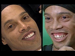 Ronaldinho faz tratamento de R$ 150 mil Ronaldinho faz tratamento de R$ 150 mil