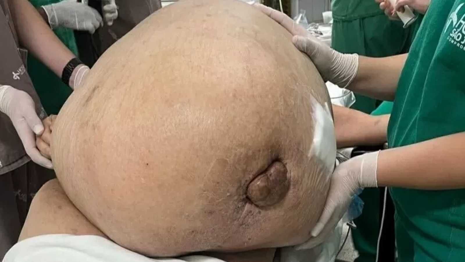 Tumor com cerca de 46 kg é retirado de mulher em cirurgia de emergência Tumor com cerca de 46 kg é retirado de mulher em cirurgia de emergência
