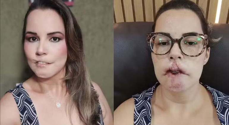 PMMA: os perigos do uso após caso de influencer perder parte do lábio PMMA: os perigos do uso após caso de influencer perder parte do lábio