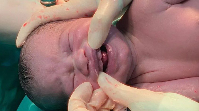 Bebê nasce com dentes e surpreende equipe médica bebê, dentes, equipe, médica, Brasil