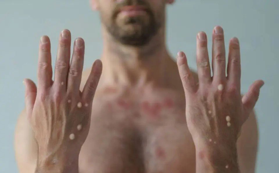 mpox, pernambuco, suspeita