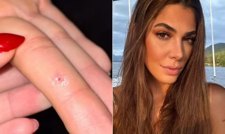 Estudante afirma ter sido infectada com HPV após tocar em aparelho de academia; entenda estudante, academia, hpv