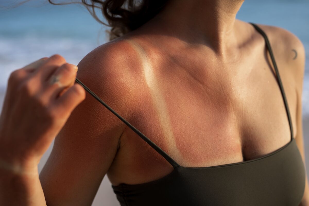 52% da Geração Z desconhecem riscos das queimaduras solares; veja como se proteger 52% da Geração Z desconhecem riscos das queimaduras solares; veja como se proteger