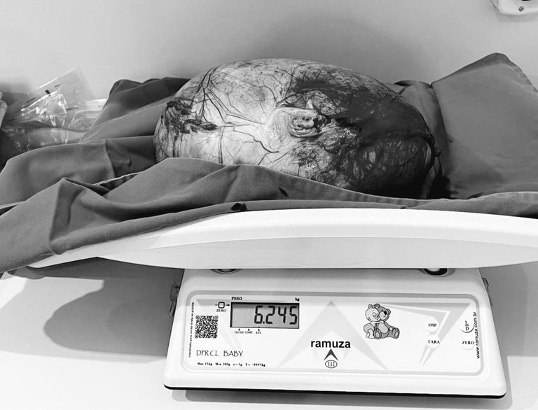 cisto gigante, guarabira, 6,2kg